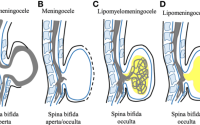 Spina bifida easy drawing