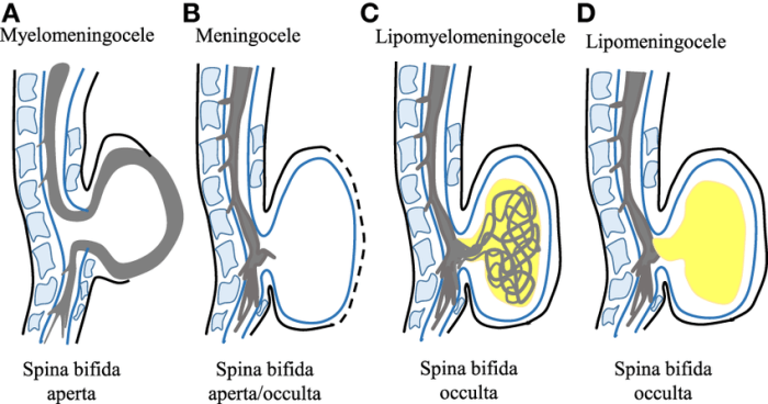 Spina bifida easy drawing