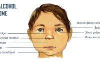 Fetal alcohol syndrome easy drawing