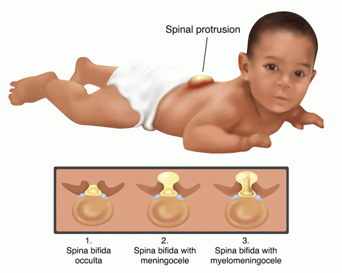 Spina bifida easy drawing